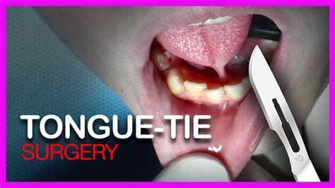 nytimes tongue tie|what is tongue tie surgery.